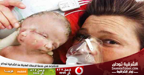 بالصور.. ولادة طفلة بوجهين ودماغين بأستراليا 11 طفله بوجهين