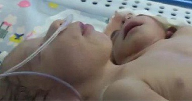 وفاة الطفل المولود برأسين وقلبين بسبب ضيق فى التنفس 1 1020143116505