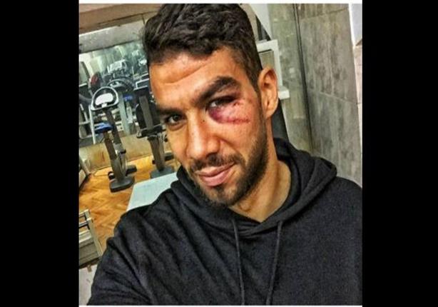 إكرامي ينشر أول صورة لإصابته القوية في الوجه 2 2016_1_14_12_56_53_661