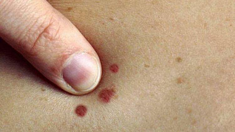 العلاقة بين الشامات وسرطان الجلد