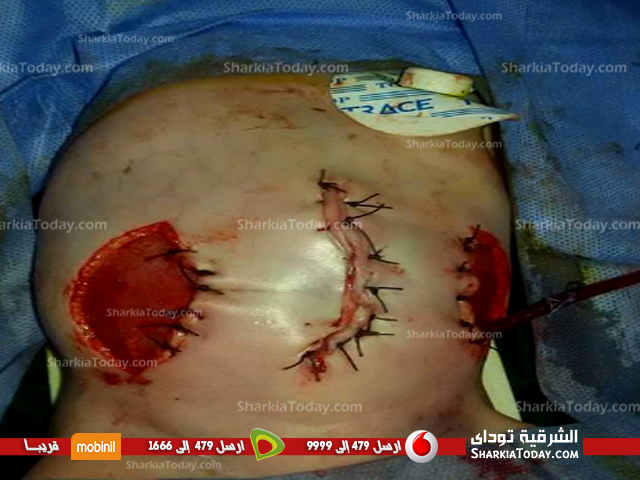رحلة معاناة طفلة بفاقوس ولدت بالأمعاء خارج الجسم 3 طفلة فاقوس 3