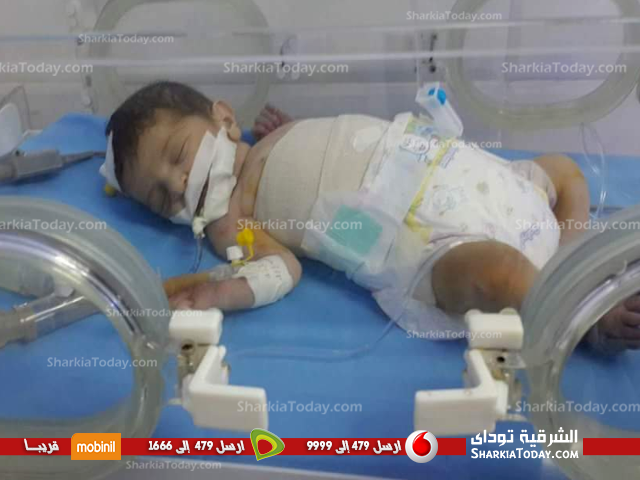 رحلة معاناة طفلة بفاقوس ولدت بالأمعاء خارج الجسم 1 طفلة فاقوس