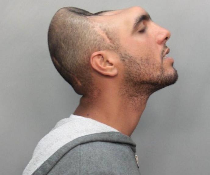 شاب يعيش بنصف رأس فقط 1 شاهد شاب يعيش بنصف رأس فقط