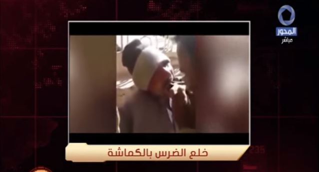 خلع الضرس بالكماشة