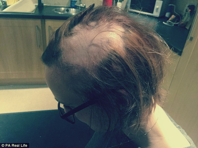 فتاة إنجليزية تخسر شعرها بسبب غير متوقع