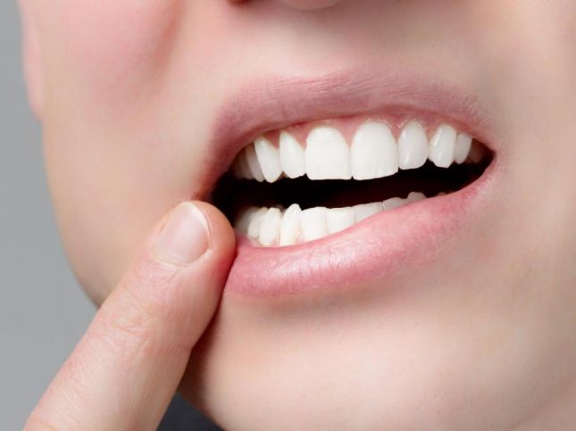 3 وصفات طبيعية للقضاء على تقرحات الفم