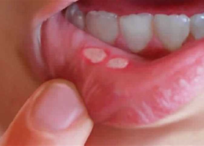 أفضل طريقة للتخلص تماماً من قرح الفم