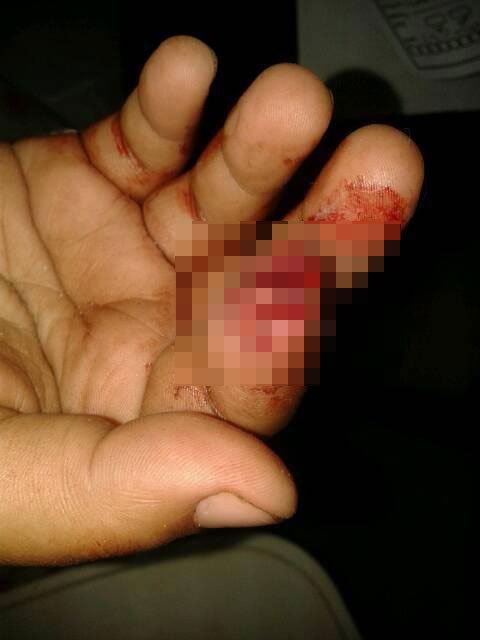 سيدة تقطع إصبع جارتها بأسنانها بسبب لهو الأطفال في أبوكبير