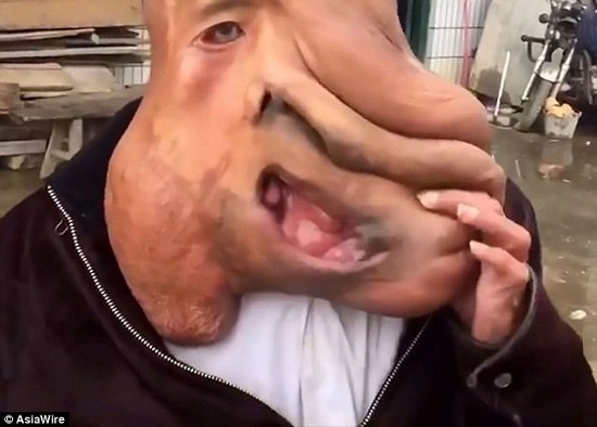 الرجل الفيل صاحب أكبر ورم فى العالم