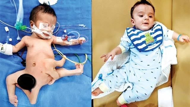 نجاح أول عملية جراحية في العالم لطفل عراقي مولود بـ8 أطراف