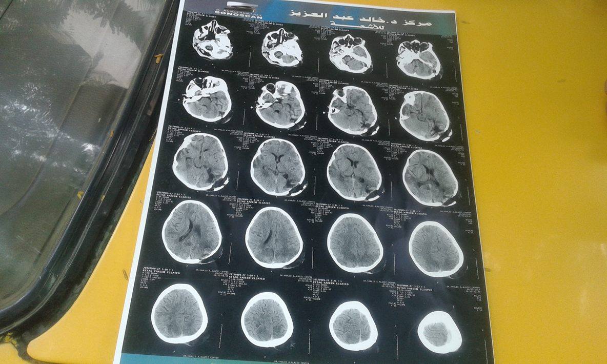 مأساة الطفلة «ريتاج» ابنة أبوكبير فقدت البصر والنطق بسبب الإهمال الطبي 5 مأساة الطفلة ريتاج.. فقدت البصر والنطق بسبب غياب ضمير الطبيب 4