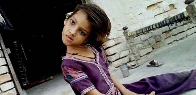 حالة نادرة لطفلة تحمل رأسا بزاوية 180 درجة على جانب جسدها 1 %D8%AD%D8%A7%D9%84%D8%A9 %D9%86%D8%A7%D8%AF%D8%B1%D8%A9 %D9%84%D8%B7%D9%81%D9%84%D8%A9 %D8%AA%D8%AD%D9%85%D9%84 %D8%B1%D8%A3%D8%B3%D8%A7 %D8%A8%D8%B2%D8%A7%D9%88%D9%8A%D8%A9 180 %D8%AF%D8%B1%D8%AC%D8%A9 %D8%B9%D9%84%D9%89 %D8%AC%D8%A7%D9%86%D8%A8 %D8%AC%D8%B3%D8%AF%D9%87%D8%A7