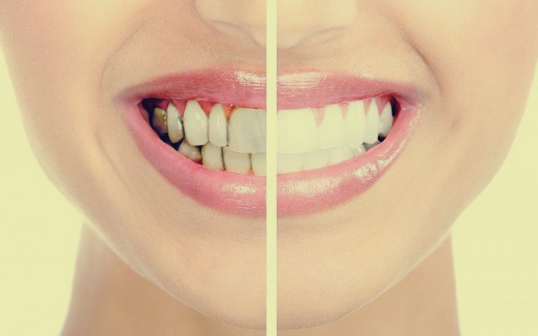 8 طرق لتبييض الأسنان الصفراء بمكونات منزلية 11 4 طرق لإزالة جير الأسنان في المنزل