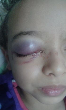 أمر طفلة تشكو معلمي مدرسة بأبوحماد بعد إصابة نجلتها بعاهة مستديمة 2