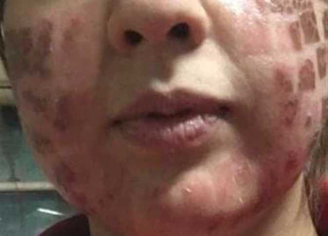 ذهبت لمركز تجميل استعداداً لزفافها فخرجت بتشوهات 1 775247 0
