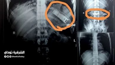 بعد مرور 7 شهور.. الأشعة تكشف تليفون محمول في معدة مريض بالقليوبية 1 بعد مرور 7 شهور.. الأشعة تكشف تليفون محمول في معدة مريض بالقليوبية