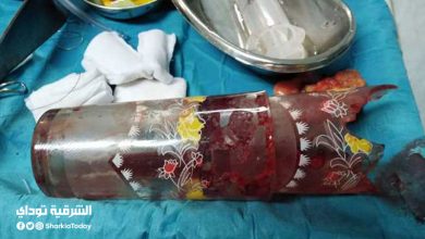 استخراج كوبين زجاج من قولون شاب في جراحة بمستشفى المنصورة التخصصي