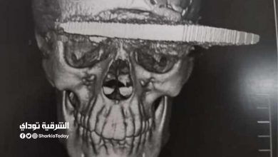 الظهور الأول لـ"سيدة الساطور" بعد عملية استغرقت 7 ساعات.. صور 2 سيدة الساطور