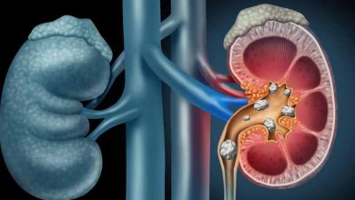 طريقة الوقاية من من حصوات الكلى