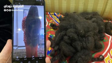 طفلة تصاب بصلع دائم بسبب إهمال الكوافير: كانوا بيحسدوها على شعرها (صور) 5 طفلة تصاب بصلع دائم