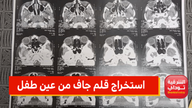 "ظل في عينه شهرين".. تفاصيل استخراج قلم جاف من عين طفل بالزقازيق (صور) 4 استخراج قلم جاف من عين طفل